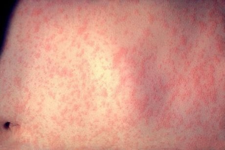 Exposure warning after confirmed measles case in Toowoomba