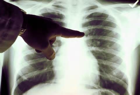 New generation of drugs called anti-PD1s and anti-PDL1s hailed by doctors as a potential cure for lung cancer