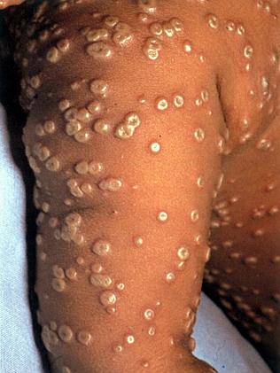 Forgotten scourge ... Smallpox lesions can leave a child disfigured for life.