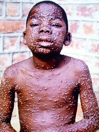 Disfiguring disease ... Young victim covered in sores from smallpox.