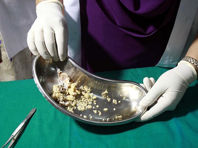 Mouthful ... teeth which were removed from 17-year-old Indian teen Ashique Gavai's mouth 