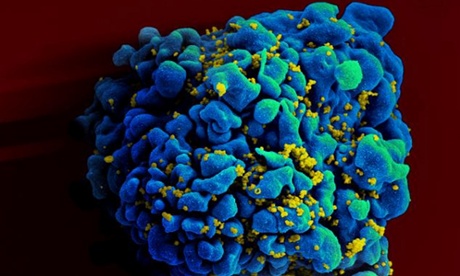 An electron microscope image showing an H9 T cell, blue, infected with the human immunodeficiency virus (HIV), yellow.