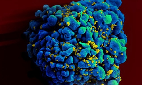 An H9 T cell, blue, infected with the human immunodeficiency virus (HIV), yellow.