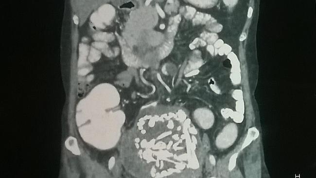 Rare... A CT scan shows the mass containing the bones of a dead foetus which doctors remo