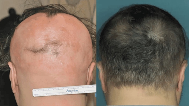 Breakthrough: Scientists May Have Found A Cure For Baldness Caused By Alopecia Areata