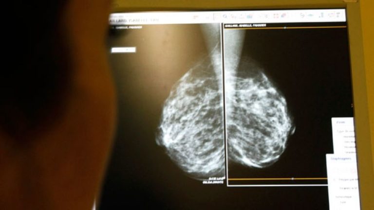 STUDY: Aspirin Cuts Risk Of Breast Cancer Recurrence In Half Among Overweight Women