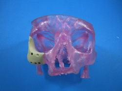 skullimge First FDA Clearance for 3D Printed Polymeric Implants for Facial Reconstruction