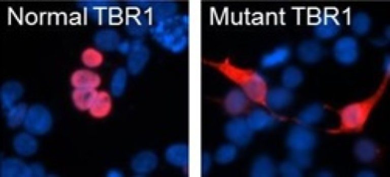 Spontaneous mutations in key brain gene are a cause of autism, study concludes