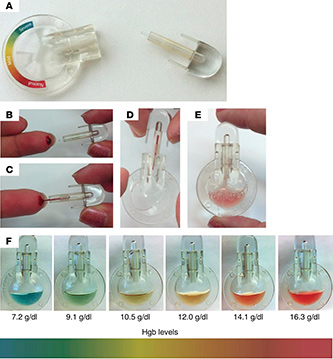 anemia testing New Home Diagnosis Technology for Anemia with Less Than a Drop of Blood