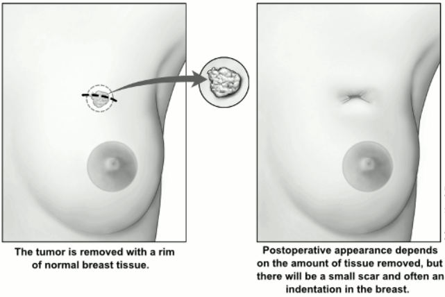 The use of breast conserving therapy, a much less invasive alternative to mastectomy for women with early-stage breast cancer, remains fraught with disparities, the study found.