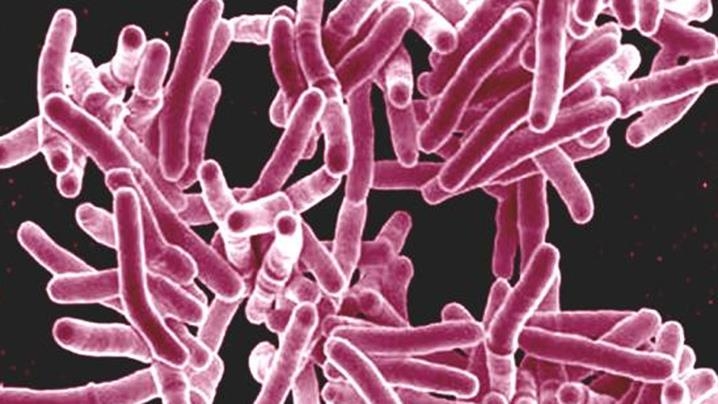 Cairns health officials in race to prevent statewide tuberculosis outbreak