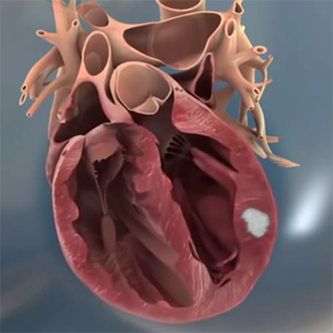 Algisyl LVR Algisyl LVR Biopolymer Injection for Advanced Heart Failure CE Marked in Europe (VIDEO)