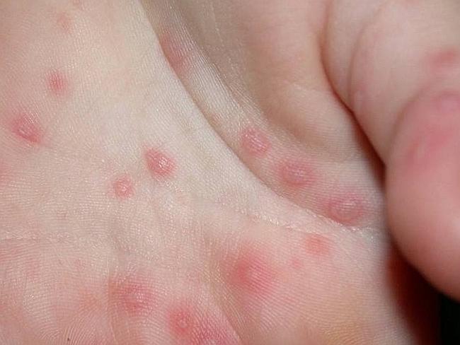 Foot and mouth disease, caused by the Coxsackie virus, has been identified as a megashock