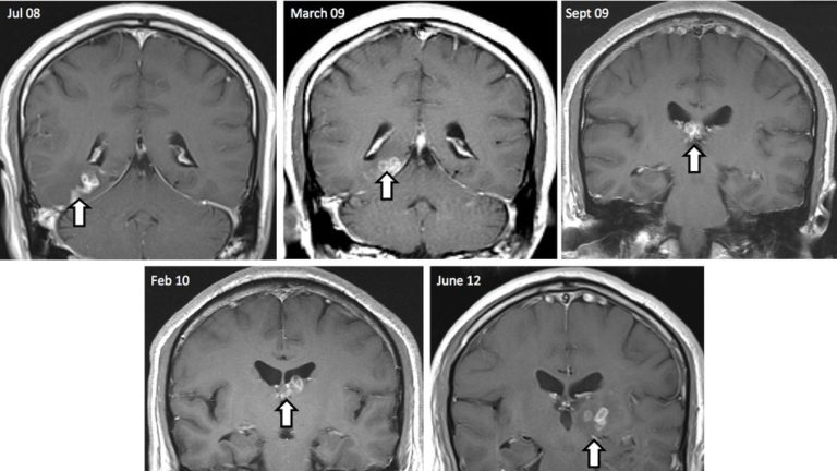 MRI scans reveal tapeworm in man’s brain