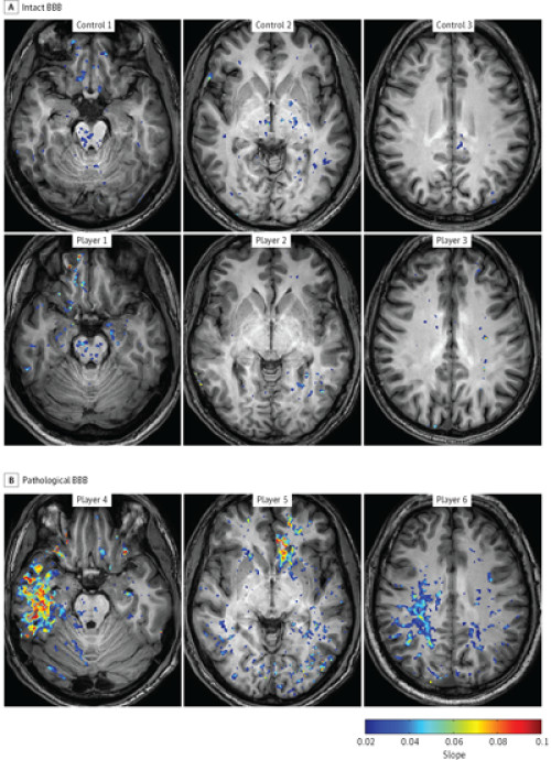 Football players found to have brain damage from mild ‘unreported’ concussions