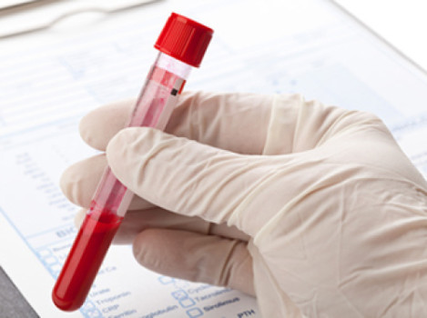 New test to measure HDL cholesterol can predict cardiovascular risk