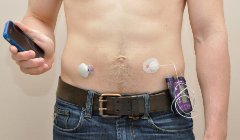 Artificial pancreas shown to improve treatment of type 1 diabetes