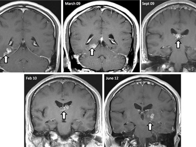 Tapeworm ... Brain scans show the parasite's movement in the man's brain over time. Pictu