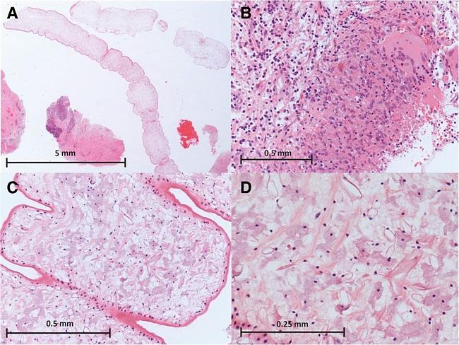 Lived inside brain four years ... Microscopic images of the recovered tapeworm. Picture: 