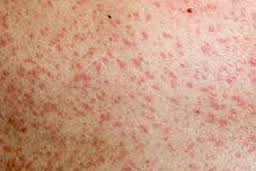 Potentially large numbers of people exposed to measles after woman tests positive for virus in southeast Queensland