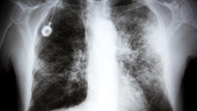 Secret cuts...X-rays and other scans could cost patients more as a result of Medibanks re