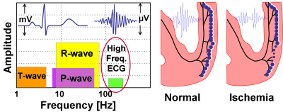 hq primer HyperQ High Res ECG Technology FDA Cleared to Diagnose Heart Attacks