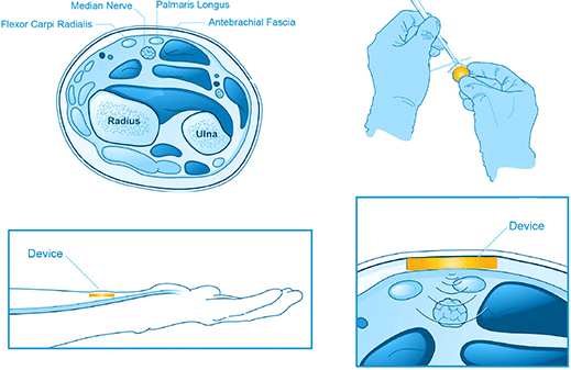 Valencia Technologies Subcutaneous Neuromodulation System for ...