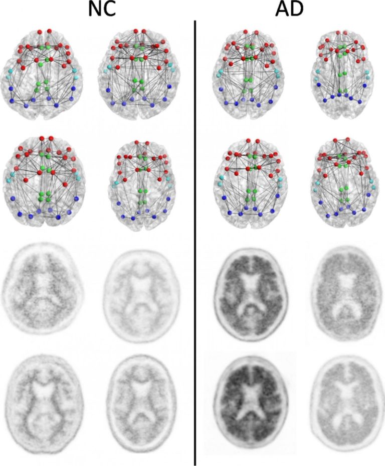 Imaging shows brain connection breakdown in early Alzheimer’s disease