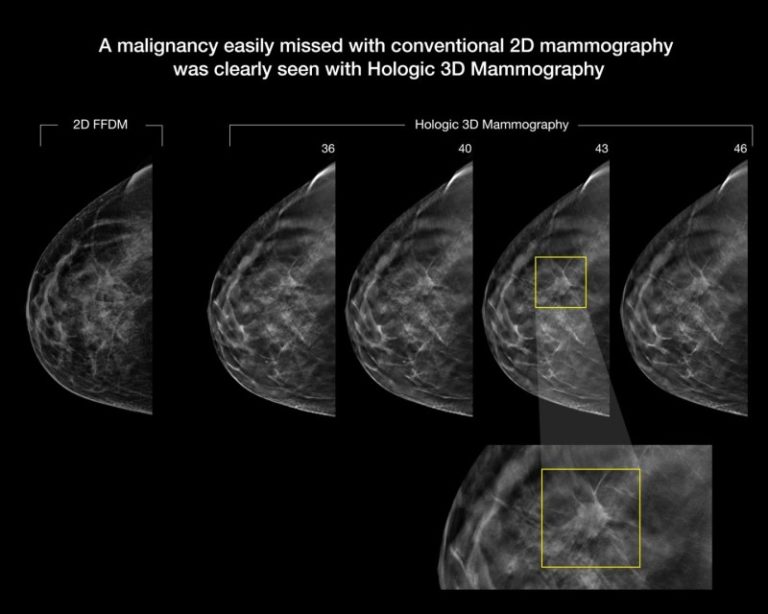 3-D mammography improves cancer detection in dense breasts