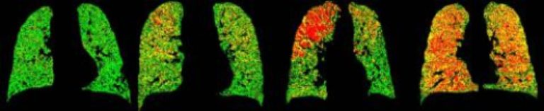 Green light from FDA for CT lung-imaging software