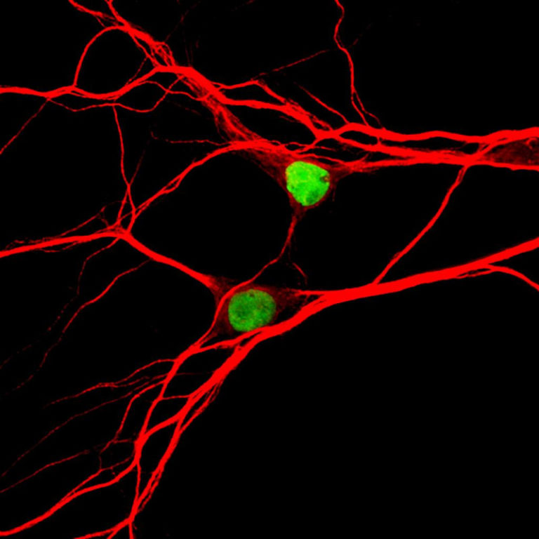 Chemo effect on brain cells pinpointed; potential link to autism