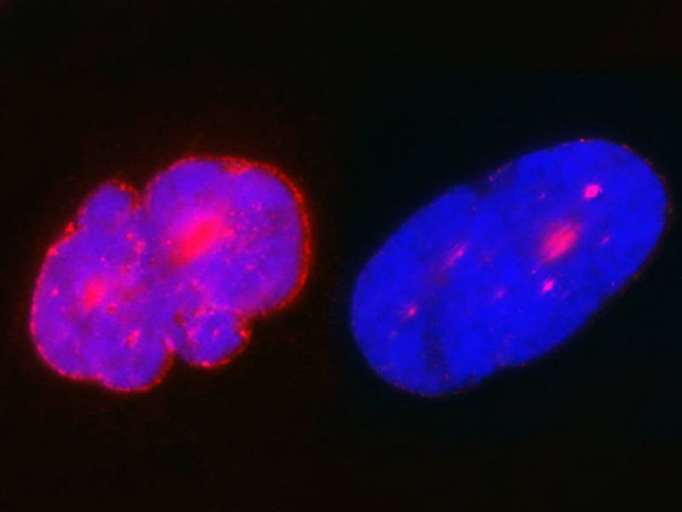 Hutchinson-Gilford Progeria syndrome: Substance from broccoli can moderate defects