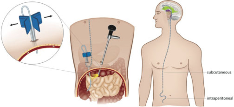 Using laparoscopy for ventriculoperitoneal shunt placement