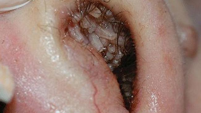 Medical shock ... It’s believed a fly laid eggs in the woman’s nose and eyes while she wa