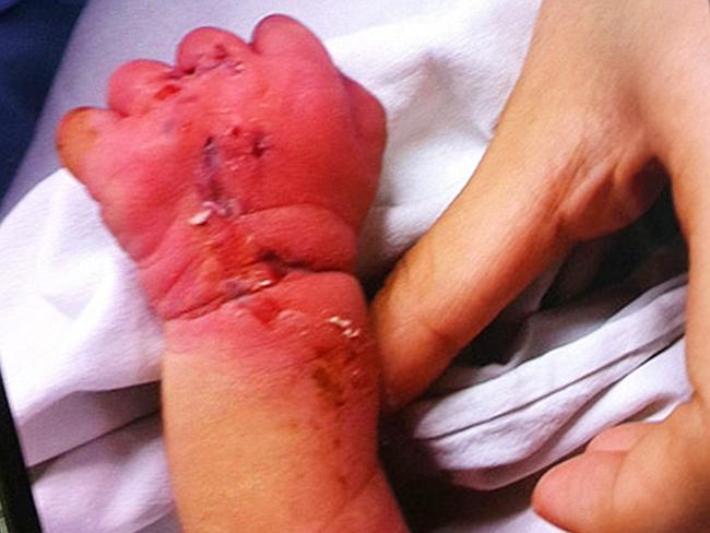 Painful ... The baby’s arm was badly damaged and suffered bruising and bleeding as a resu