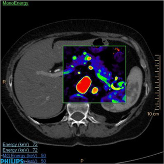 iQon spectral ct Philips IQon Spectral CT with Advanced Capabilities Now FDA Approved