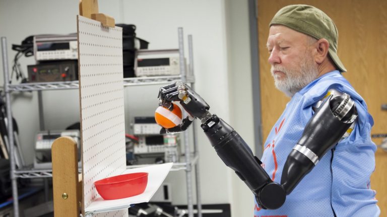 Double amputee controls bionic arms with his mind