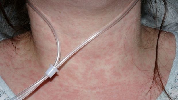 Measles alert for Brisbane’s southside