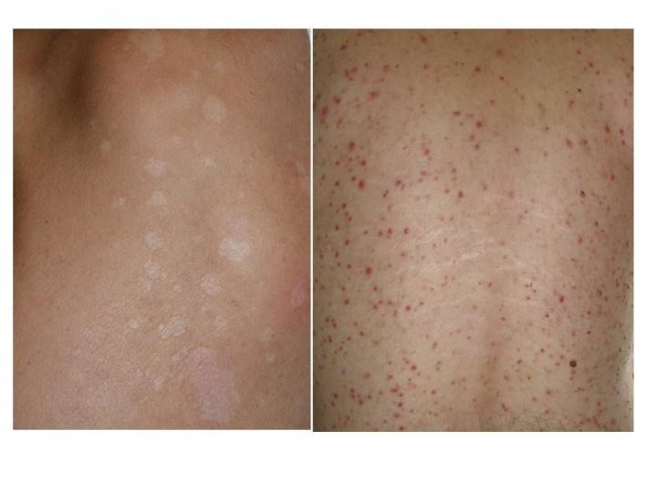 Malassezia yeasts, everywhere and sometimes dangerous