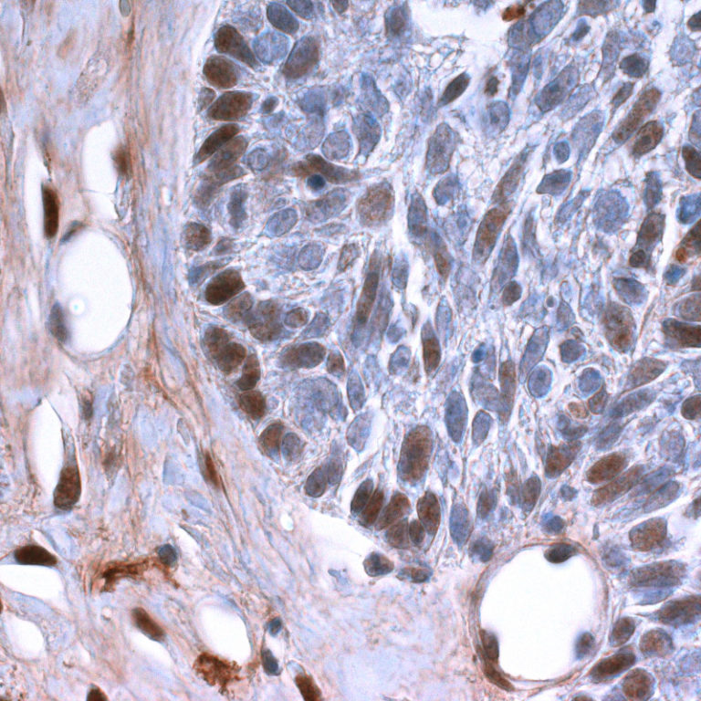 Skin cancer: New mechanism involved in tumor initiation, growth and progression