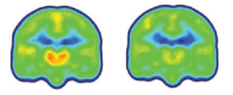 First evidence of neuroinflammation in brains of chronic pain patients