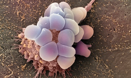 Ovarian cancer cells