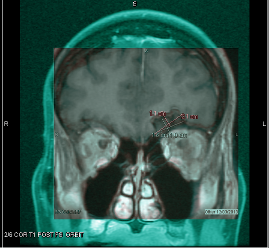 ComparisonOverlayCoronal