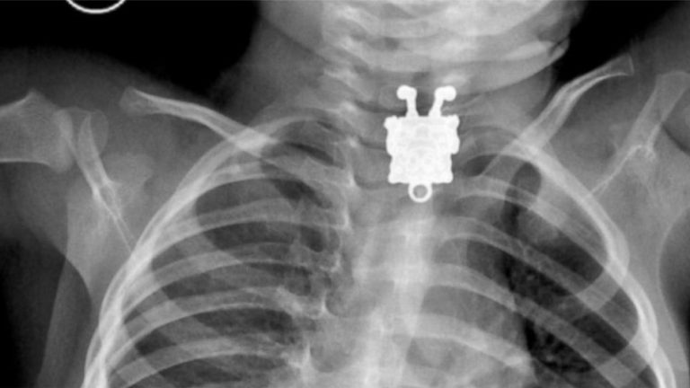 X-ray reveals SpongeBob SquarePants living in child’s throat