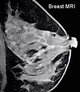 Based on their findings, the authors say women with atypical hyperplasia should discuss MRI breast screening with their doctors as a potential risk-reduction strategy.