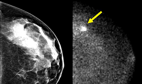 Compared to images produced by traditional mammography (pictured on the left), MBI images (on the right) more clearly distinguish tumors from surrounding breast tissue.