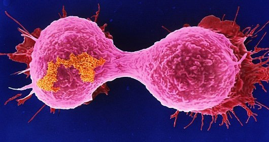 Most Cancer Cases Are Caused By Bad Luck, New Study Finds