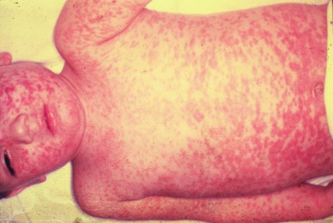 The telltale symptom of measles is a bright red rash that appears