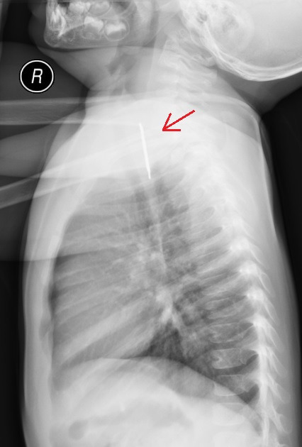 spongebob-x-ray-lateral