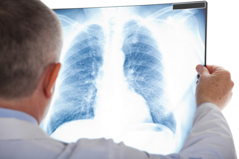 Lung cancer now leading cause of cancer death in females in developed countries